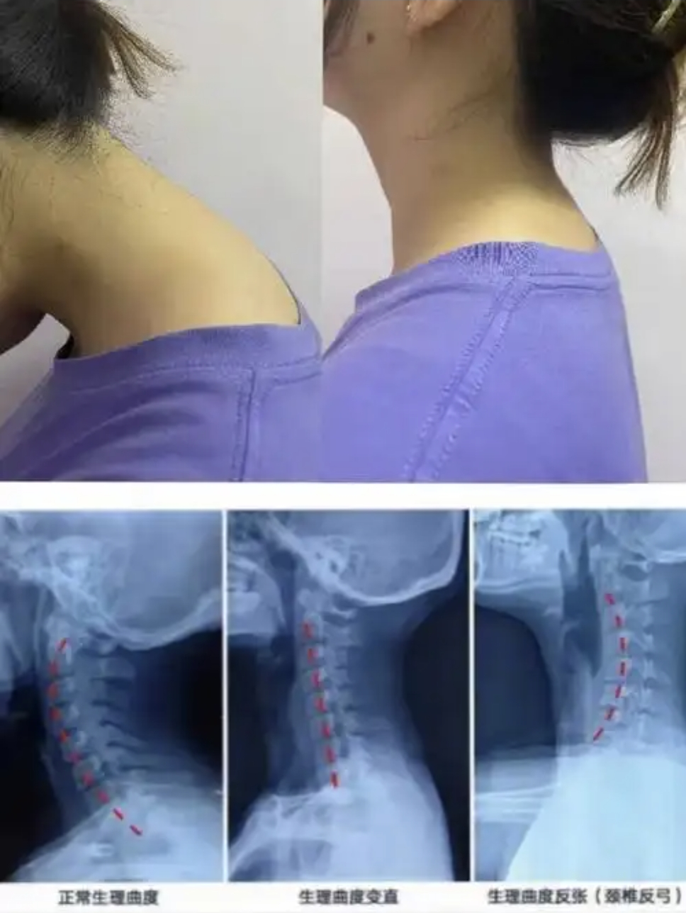 如何通过康复治疗缓解颈椎病带来的症状？