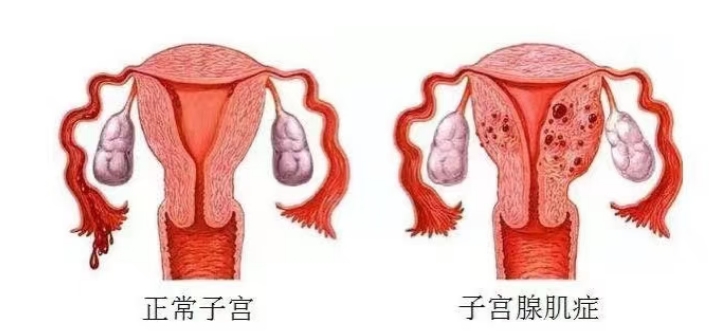 子宫腺肌症治疗不需要切子宫了，洛阳白马医院介入治疗解您忧！
