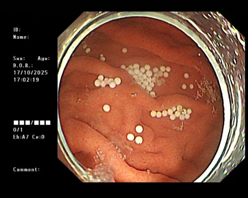 18岁少年连吃9颗布洛芬险酿大祸，消化内科洗胃术守护健康生命线！