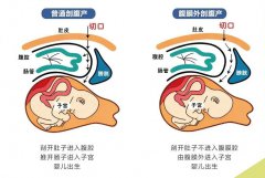 什么是腹膜外剖宫产？和传统剖宫产有何不同？