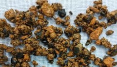 肝内结石治疗有新招，胆道镜下钬激光碎石取石