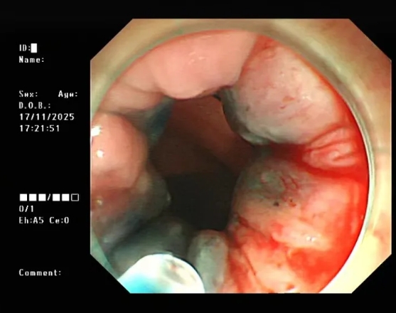 特色技术丨不开刀！内痔硬化治疗：轻松解决，当天回家