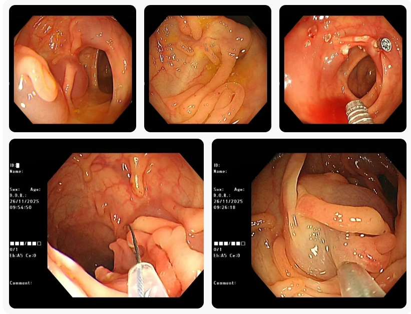 惊！七旬大爷腹痛半月余，一查肠内六十多颗息肉