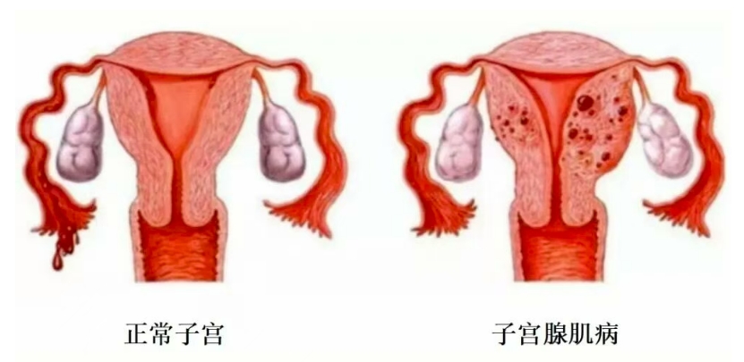 子宫腺肌症：微创介入，守护子宫，终结内在之痛