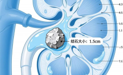 健康小课堂 | 天冷不爱动？小心泌尿结石找上门！