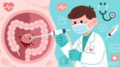 肠息肉：藏在肚子里的“定时炸弹”，你清理了吗？