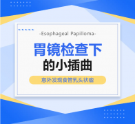 胃镜下的“小插曲”：当胃疼检查意外发现食管乳头状瘤